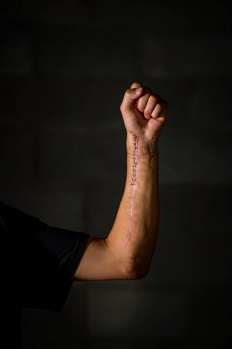 How to Reduce Arm Pump in Motocross